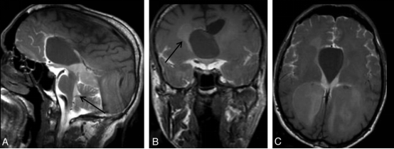 cisternography