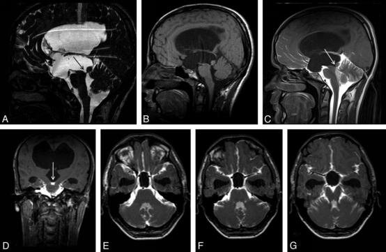 cisternography