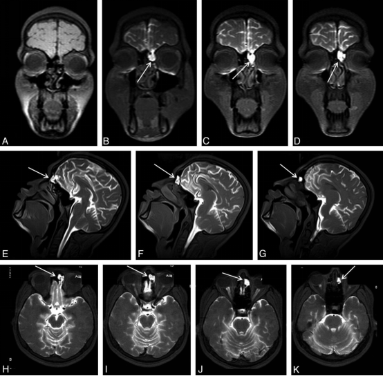 cisternography