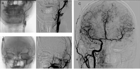 ct angio head