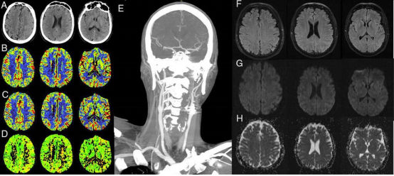 ct angio head