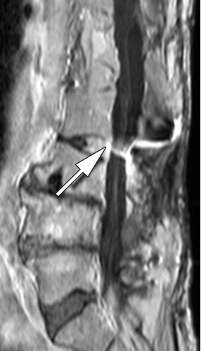 ct-myelogram