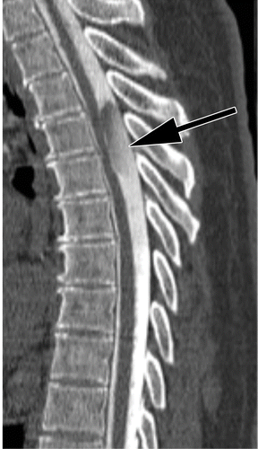 ct-myelogram