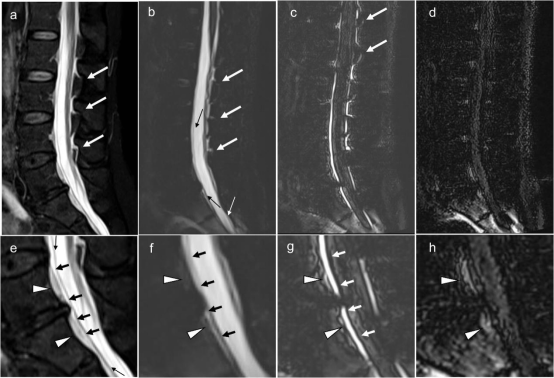 mri-myelogram