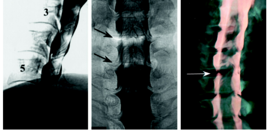 myelography