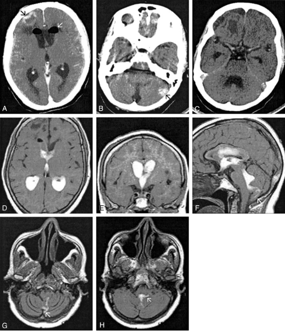 ventriculography